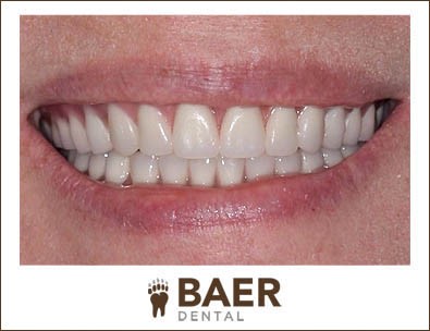 Braces With Partial Dentures Newport NJ 8345